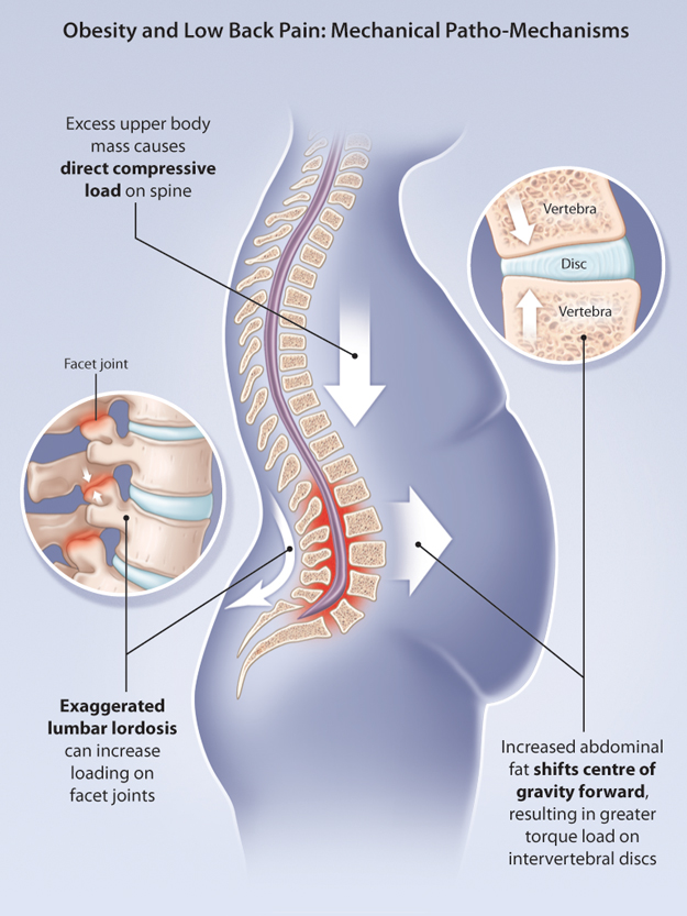 How Losing Weight Can Help Reduce Back Pain | Excel Chiropractic