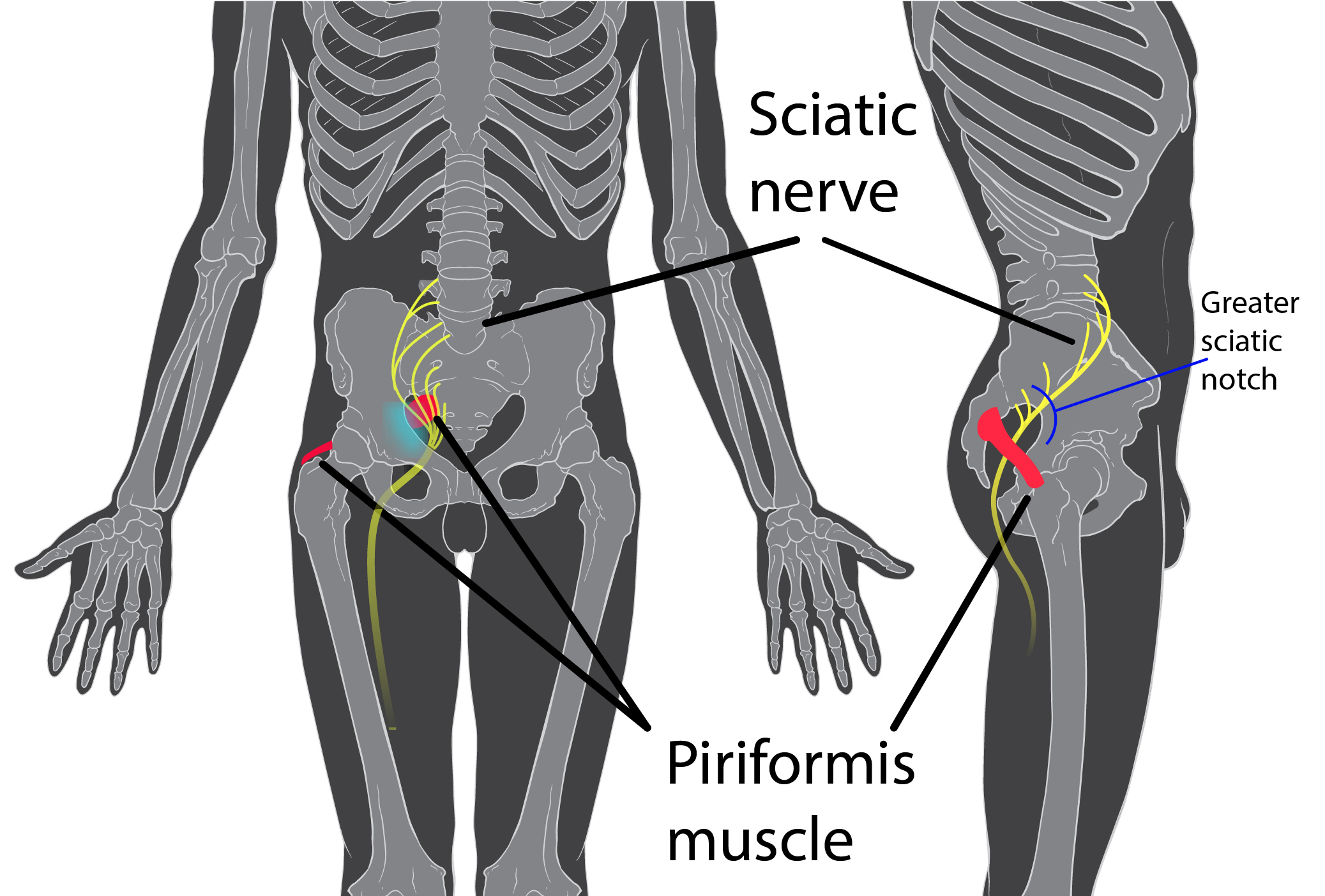 Is it Sciatica or Piriformis Syndrome? - Cold Spring Chiropractic